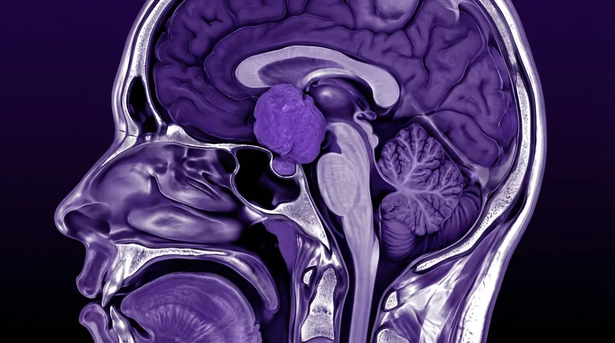 🧠 Ressecção de Craniofaringioma