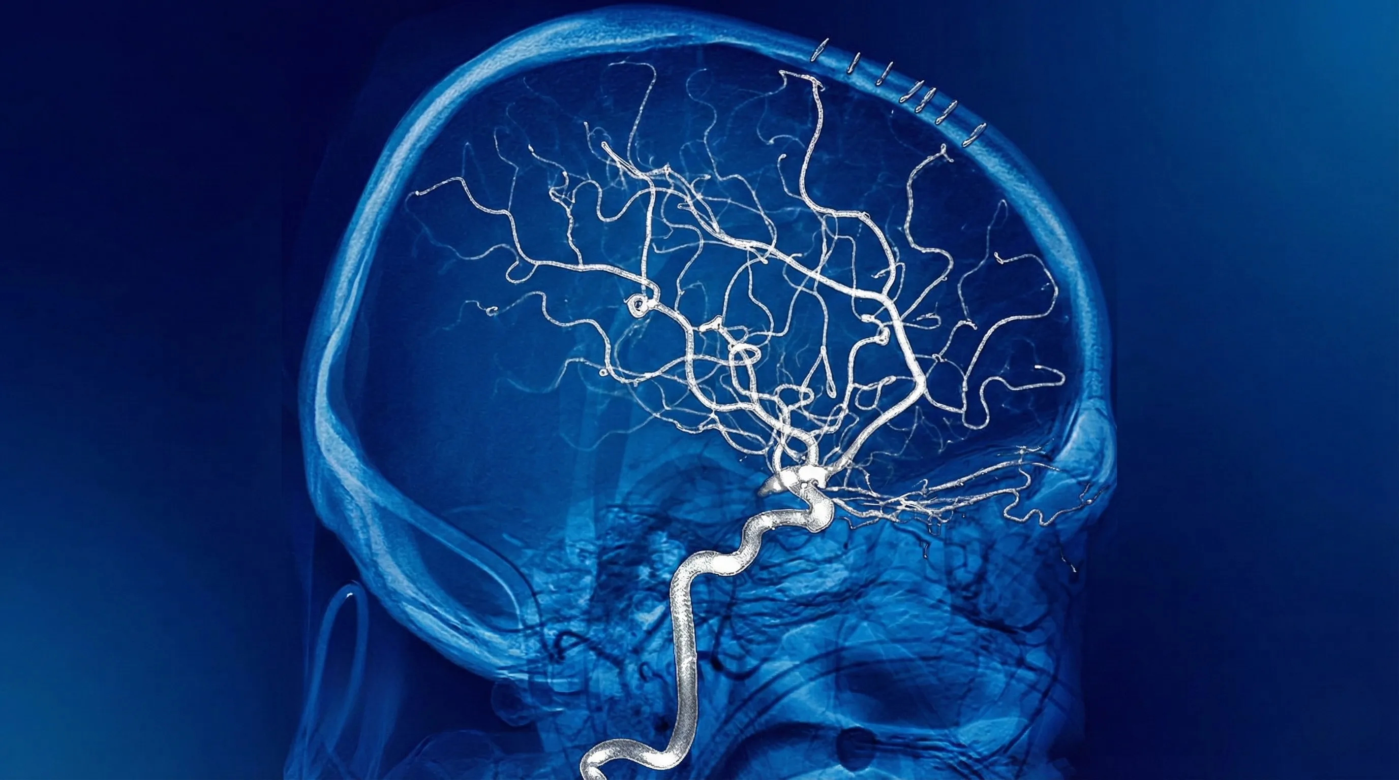 🎯 Embolização Endovascular de MAV ou Aneurisma